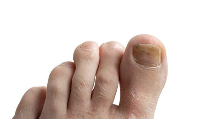 leczenie-grzybicy-paznokci