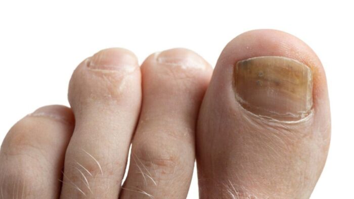 leczenie-grzybicy-paznokci